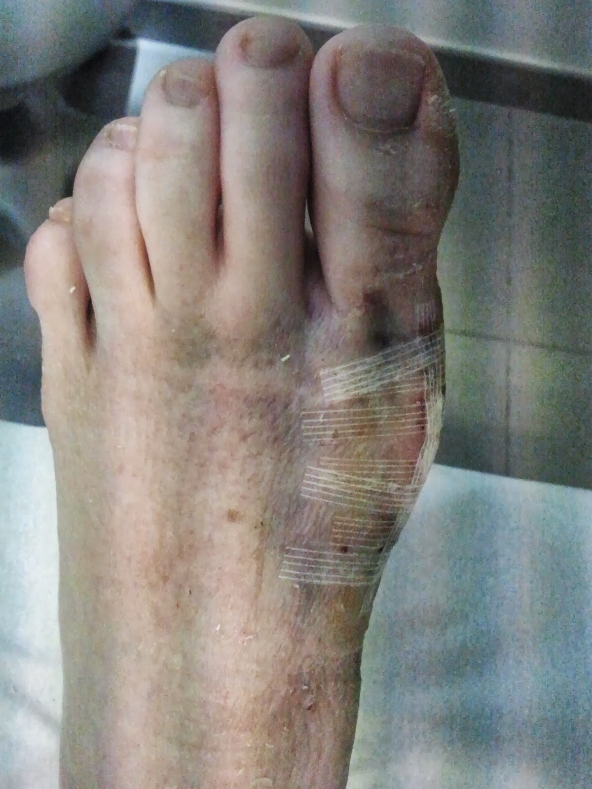 Cirugia de juanetes con tornillos